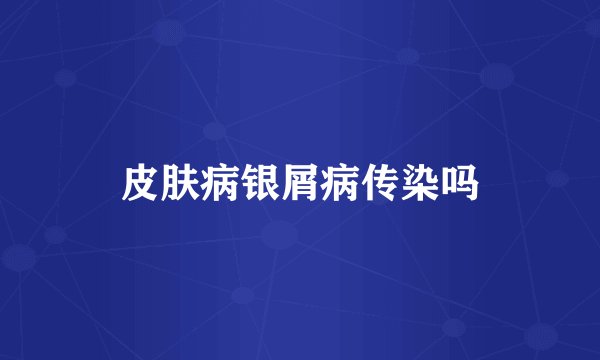 皮肤病银屑病传染吗
