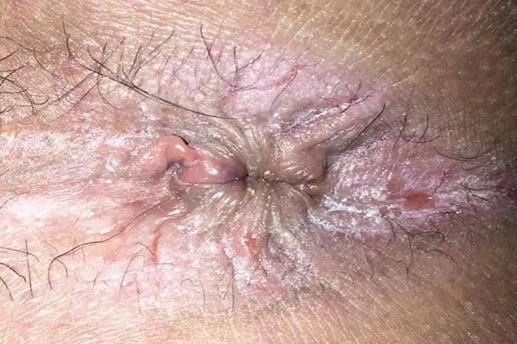 脱肛的症状和图片