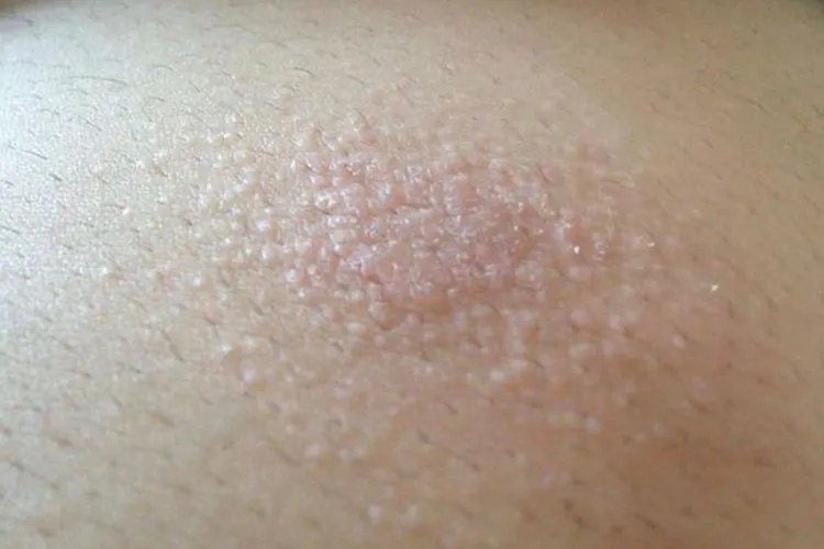 痱子长啥样图片