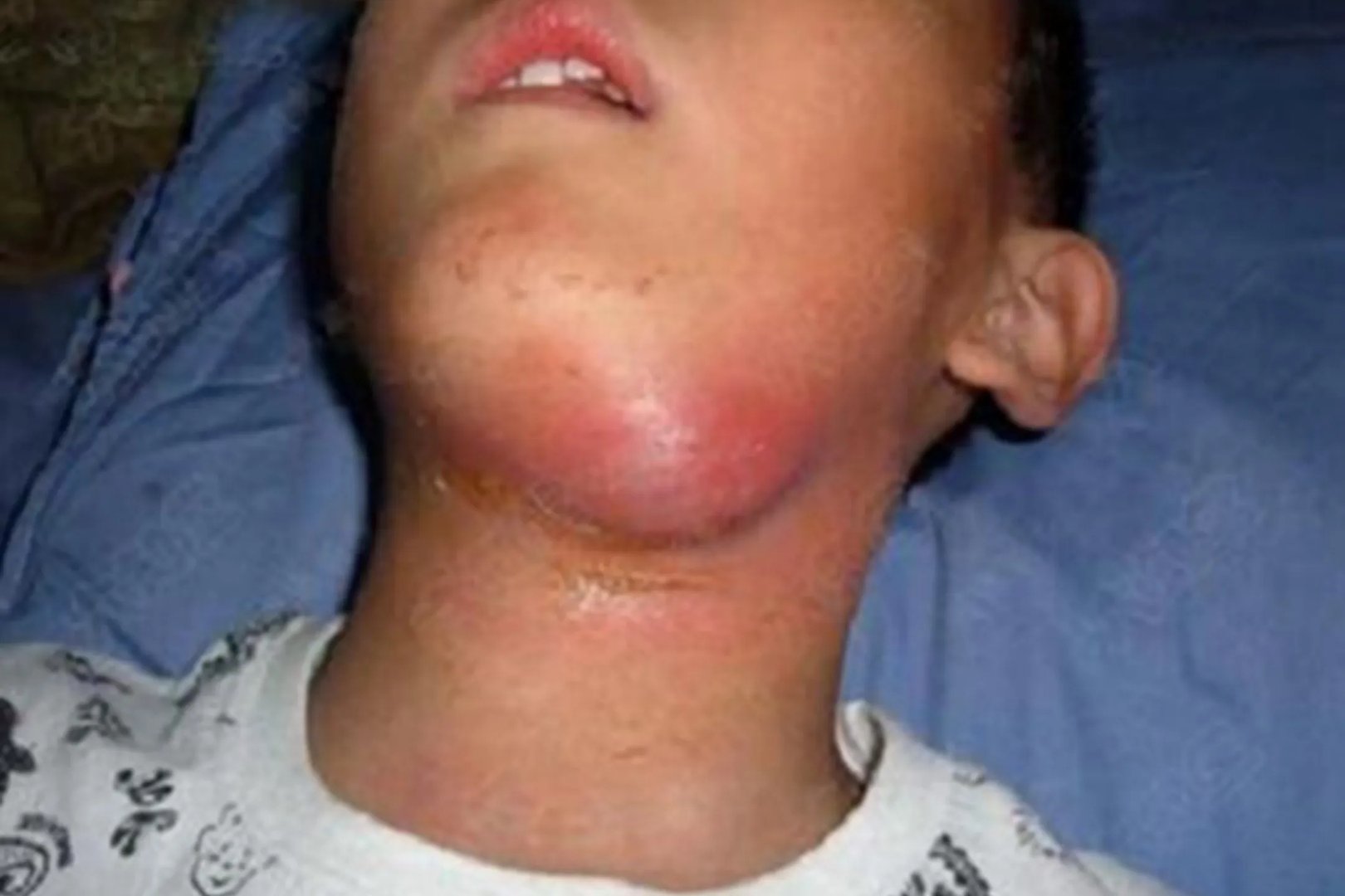 颈部淋巴结肿大图片，怎么消除