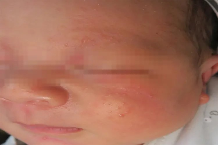 小孩湿疹图片