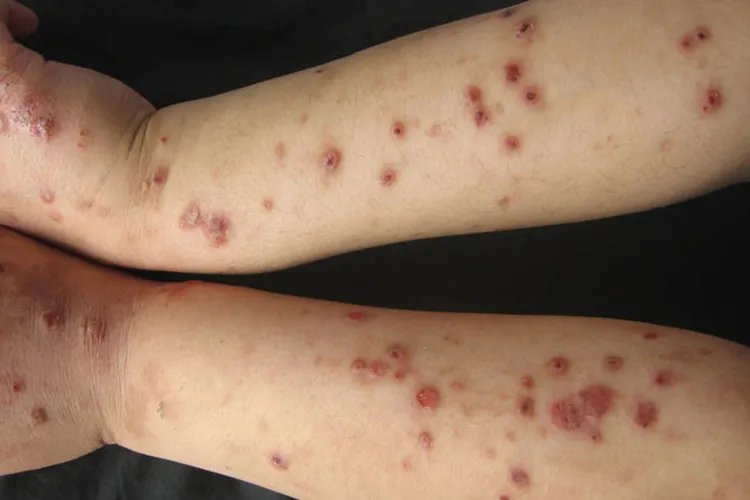 结节性痒疹图片