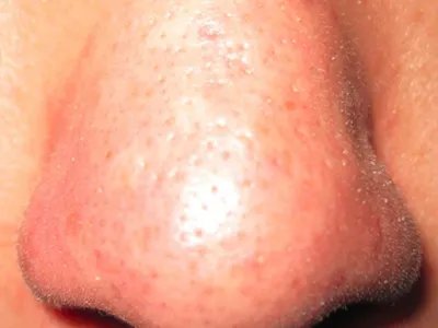 皮脂溢出白头粉刺图片