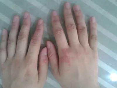 手部湿疹红斑图片