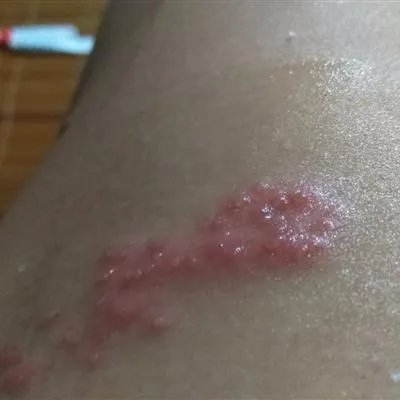 韦格纳肉芽肿怎么得的?