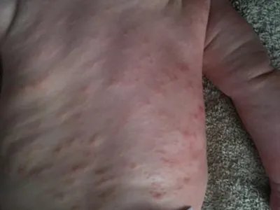 奶癣小红疙瘩图片