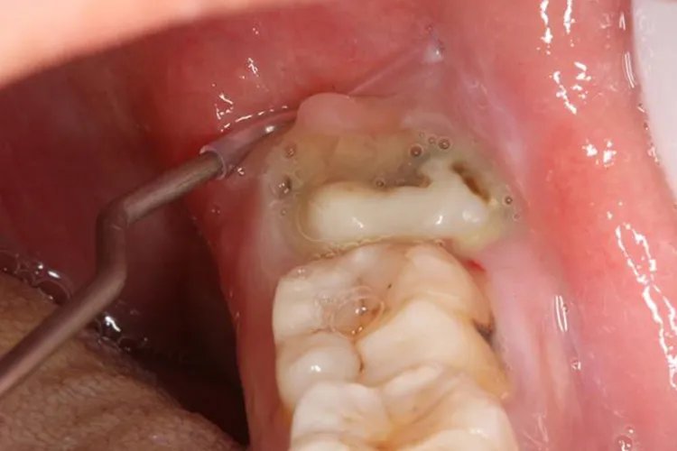 十种智齿不能拔的图片