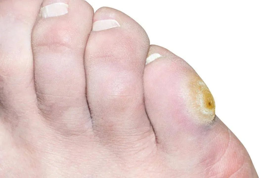 脚上皮肤病大全图