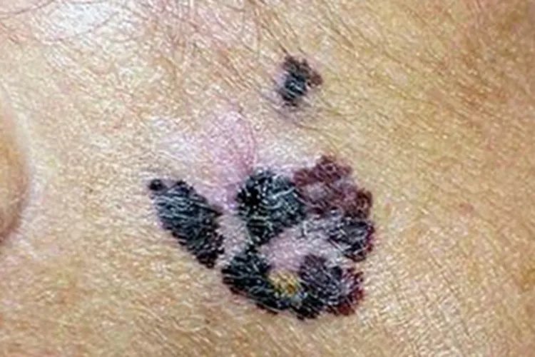 黑素瘤症状图片