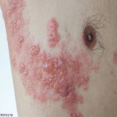 蛇胆疮怎么治疗能好