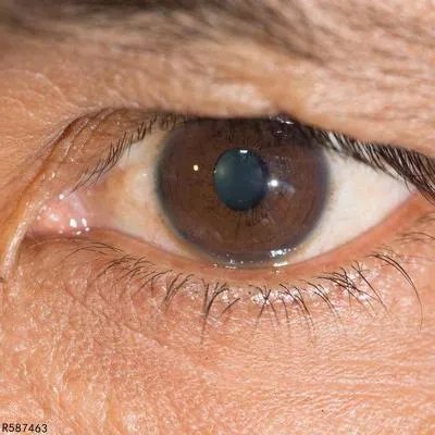 圆锥角膜注意事项有哪些