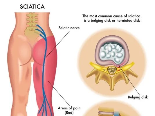格林巴利综合症如何治疗