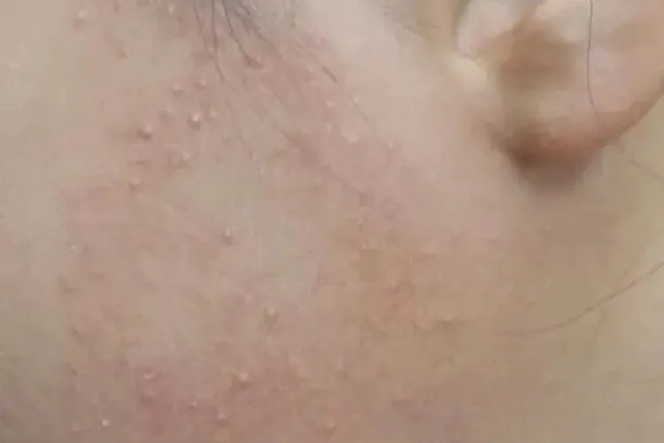 小孩鸡皮肤图片