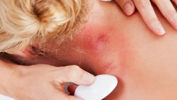 左旋咪唑是治疗什么疾病的药 左旋咪唑怎么使用效果好