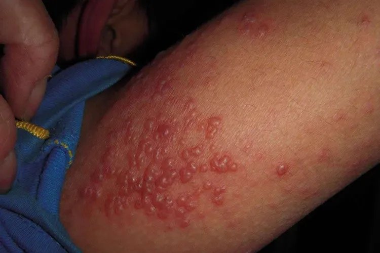 晒斑的图片是什么样的