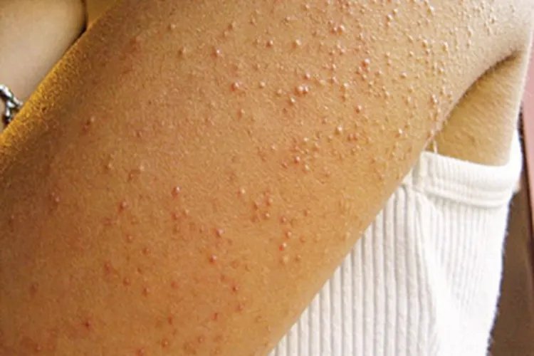 全身性瘙痒症丘疹图片