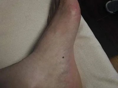 交界痣黑痣图片