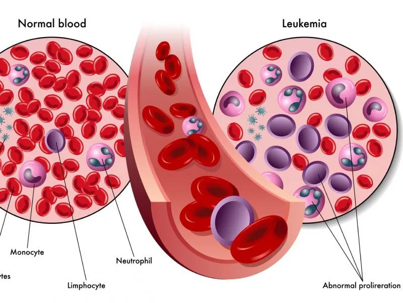 嗜血细胞综合症是什么病