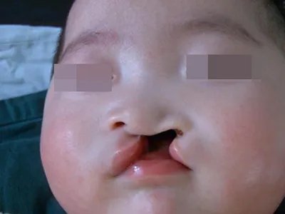 唇裂症状图片