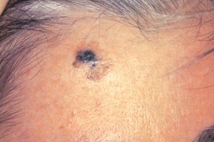 黑素瘤症状图片