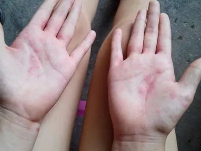 手部湿疹红斑图片
