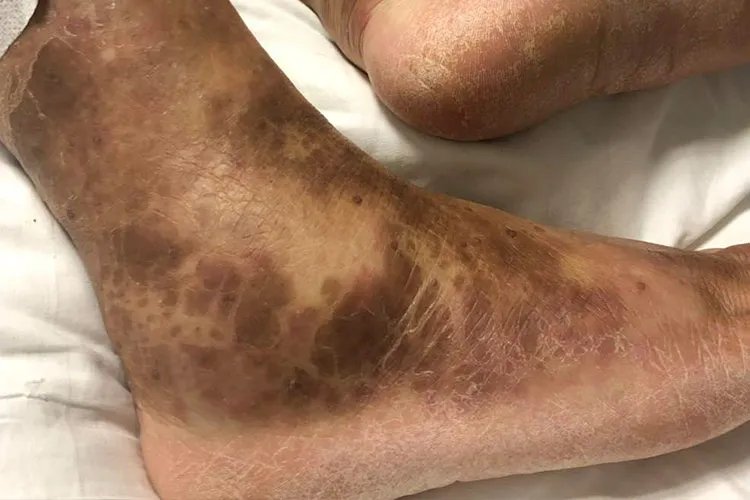 皮炎图片和症状用什么药