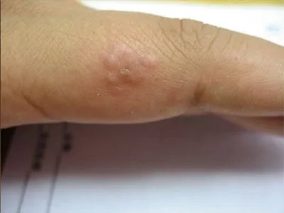 单纯疱疹水疱图片