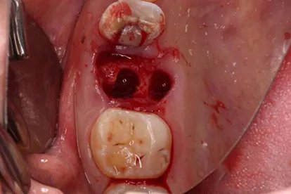 拔牙后七天窟窿恢复图