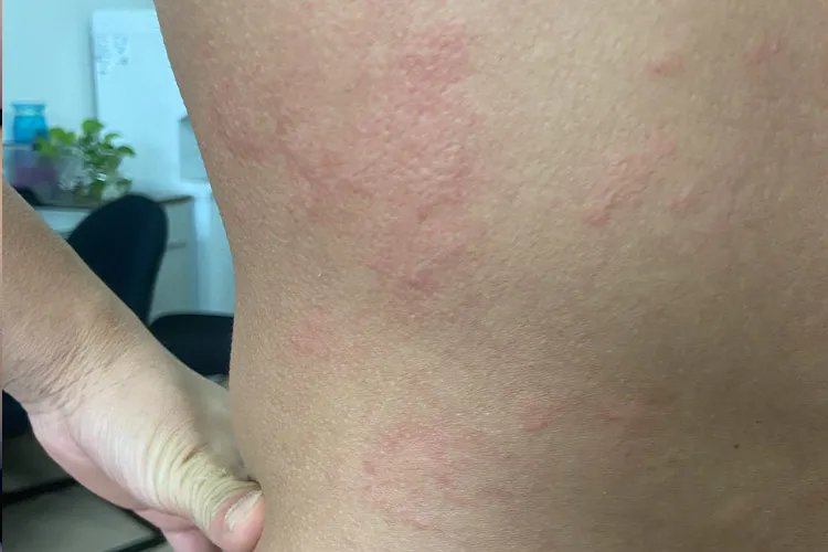 丘疹性荨麻疹的初期症状图片