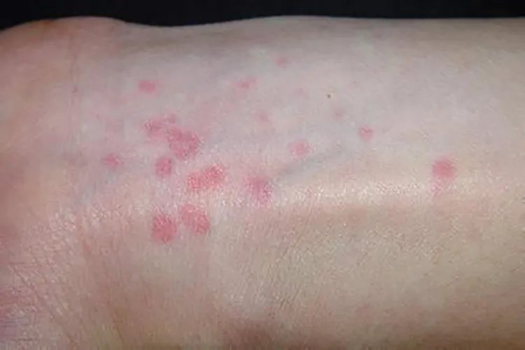 各种荨麻疹图片大全