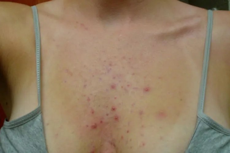 女性胸前红色凸起小痘痘图片