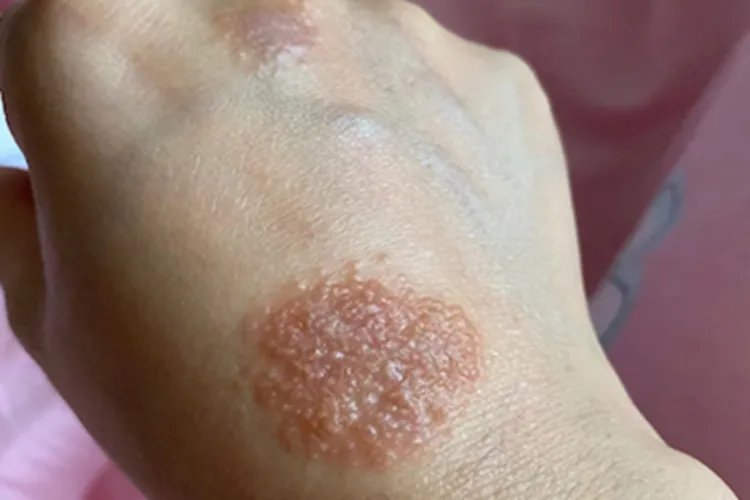 湿疹手部症状图片