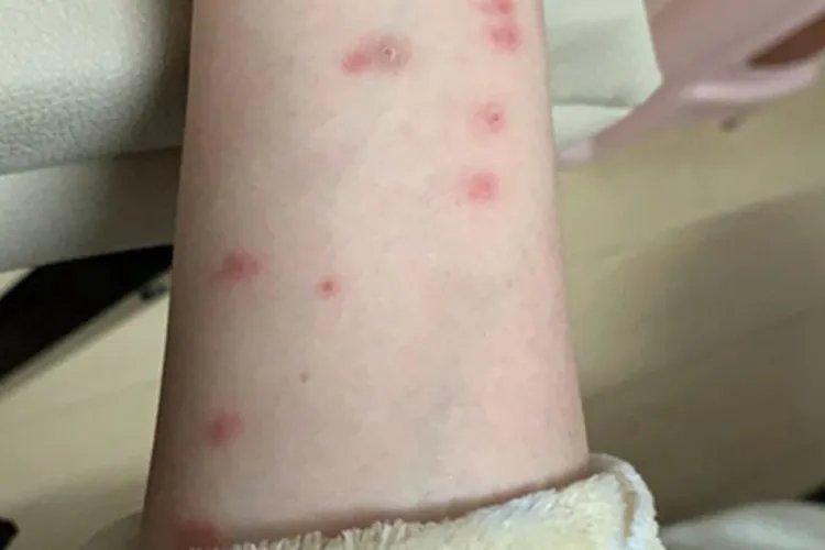 跳蚤叮咬红点图片