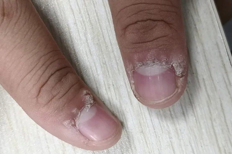 什么是刺瘊子图片大全