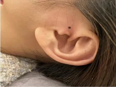 交界痣黑痣图片