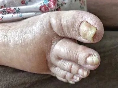 怎么治疗灰指甲 灰指甲的五大有效疗法