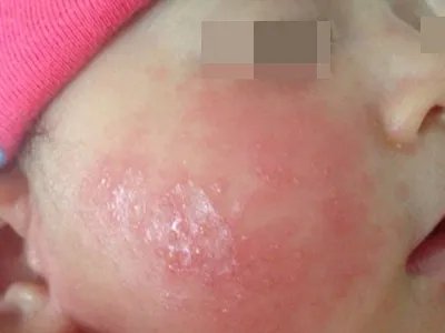 奶癣小红疙瘩图片