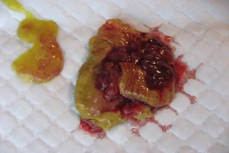 肠癌拉出来大便的图片