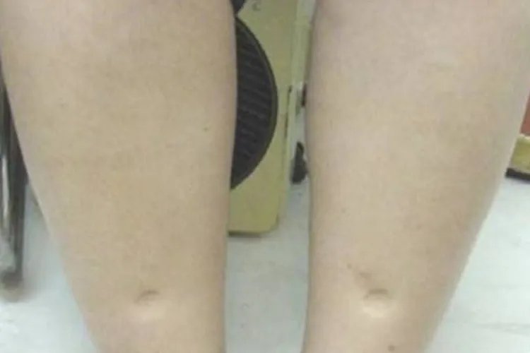 宫颈癌是什么样子实图