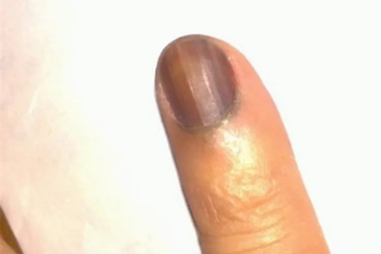 黑素瘤症状图片