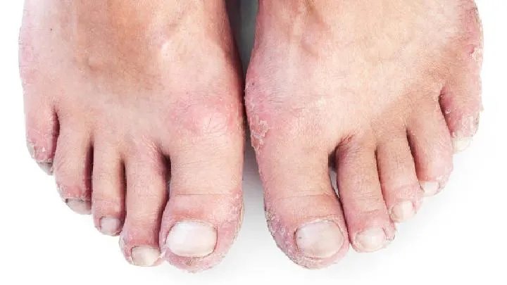 头癣怎么传播的？ 怎么预防头癣？