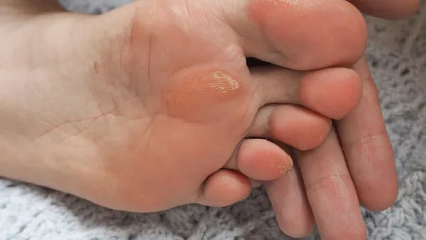 脚上起水泡怎么治疗