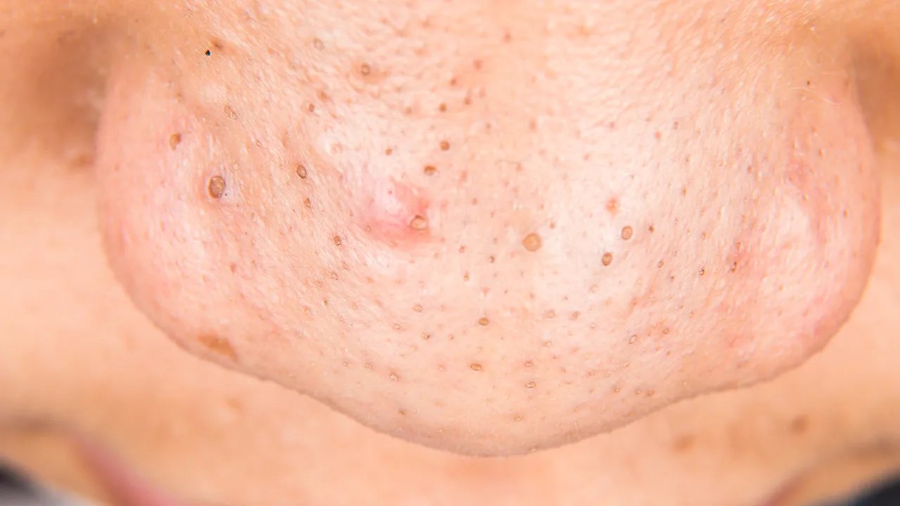 去黑头最好的方法有哪些