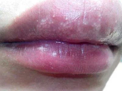 口腔白斑病嘴唇症状图片