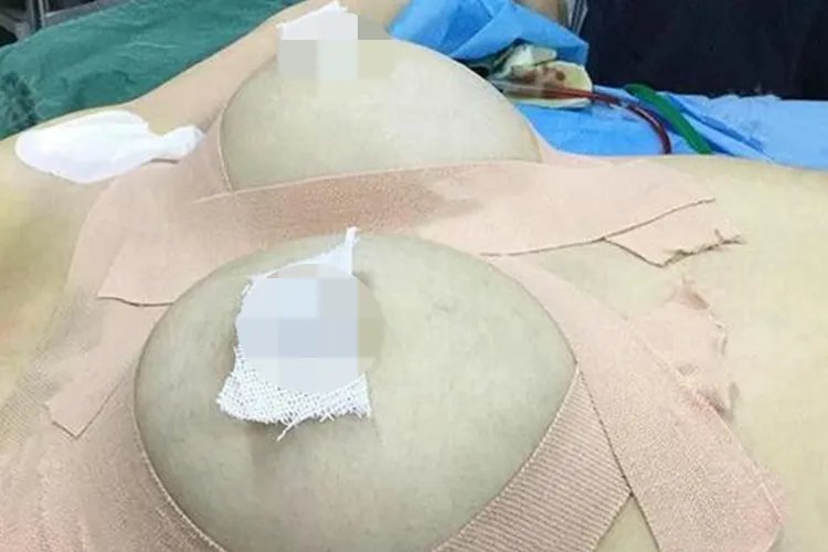 丰胸后的效果图片