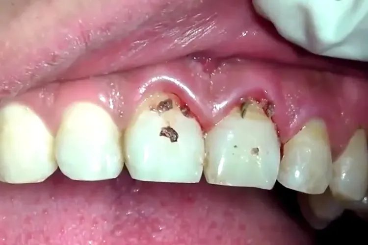 黑色牙结石图片