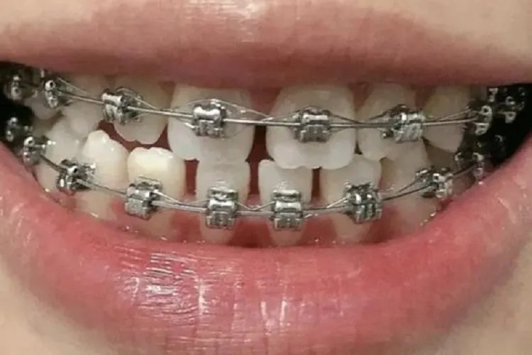 牙套分几种类型图片,有什么区别