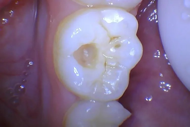 蛀牙的虫子长啥样图片