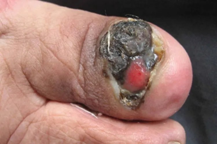 黑素瘤症状图片