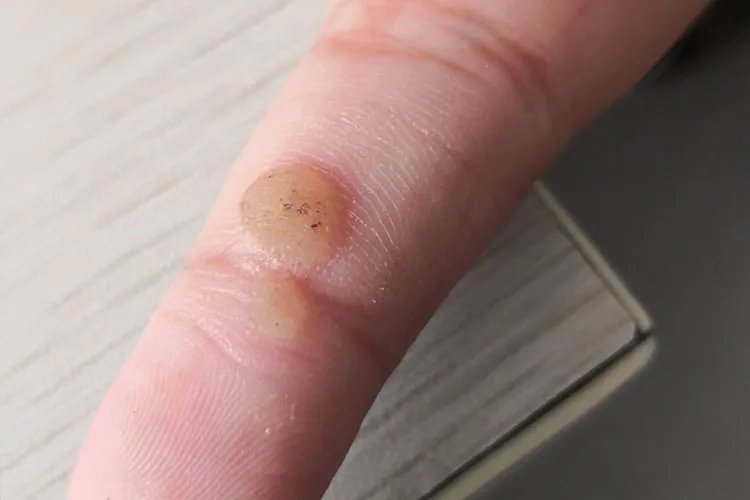 什么是刺瘊子图片大全